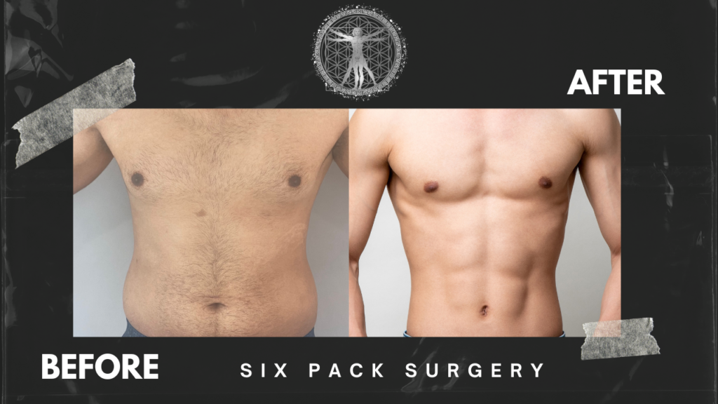Get a sculpted six pack surgery today with best plastic surgeon in Hyderabad