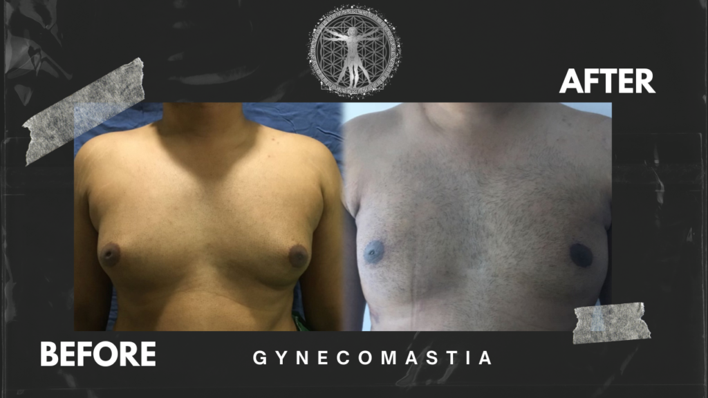 Gynecomastia before after images - Dr.Rajesh Vasu, - Dr.Rajesh Vasu, Best plastic surgeon for gynecomastia surgery