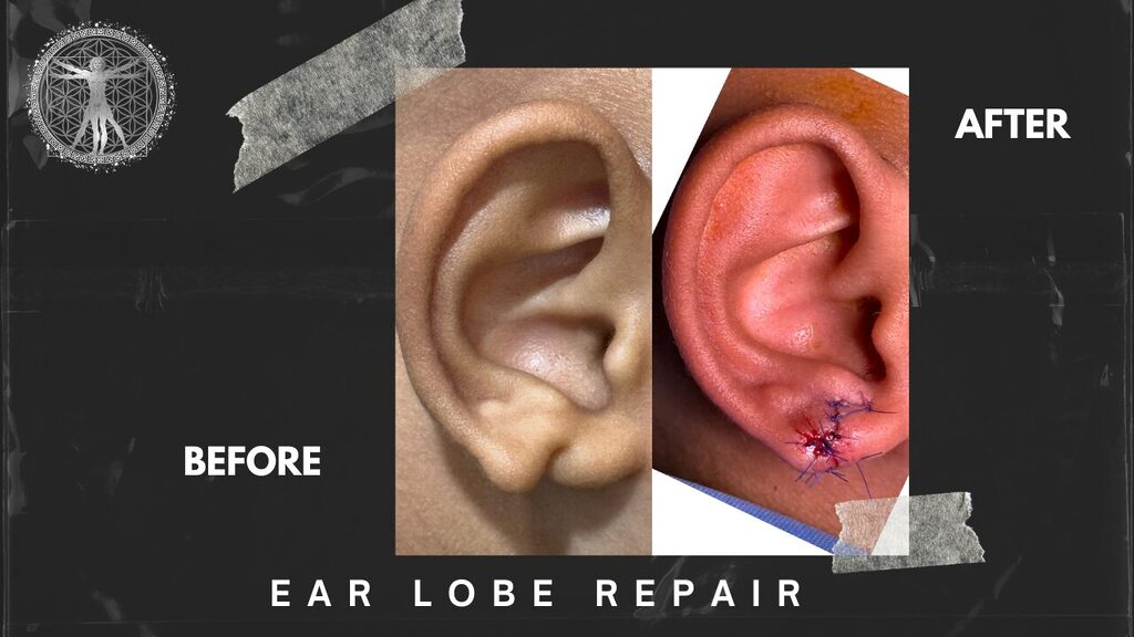 18 - Dr.Rajesh Vasu, - Dr.Rajesh Vasu, Before-and-after collage showing ear lobe repair: left ear before, right ear with sutured lobe, labeled 'After'