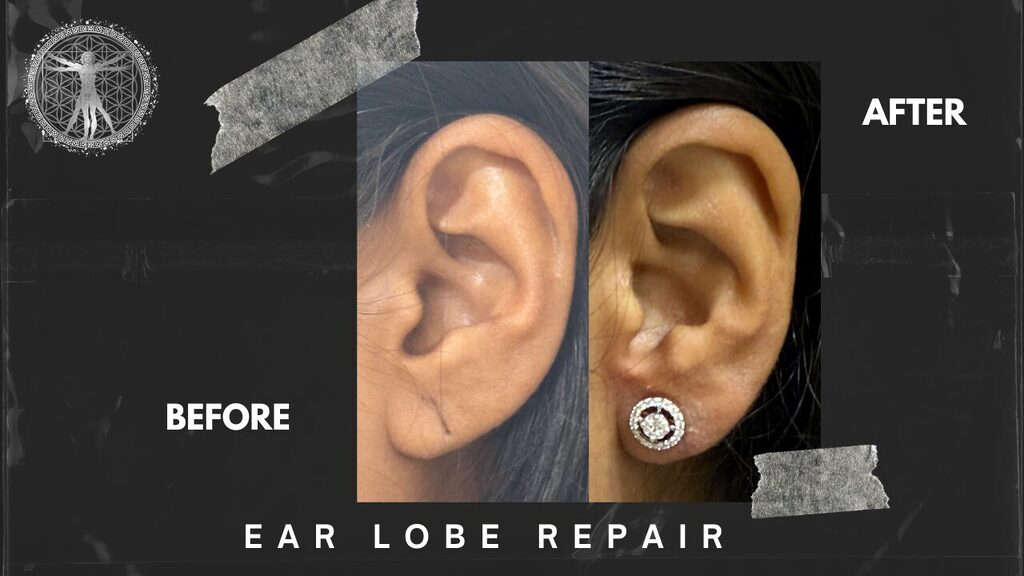 19 - Dr.Rajesh Vasu, - Dr.Rajesh Vasu, Close-up before-and-after comparison of an ear lobe repair: left side shows the pre-repair ear, right side shows the repaired ear with a sparkling stud earring.