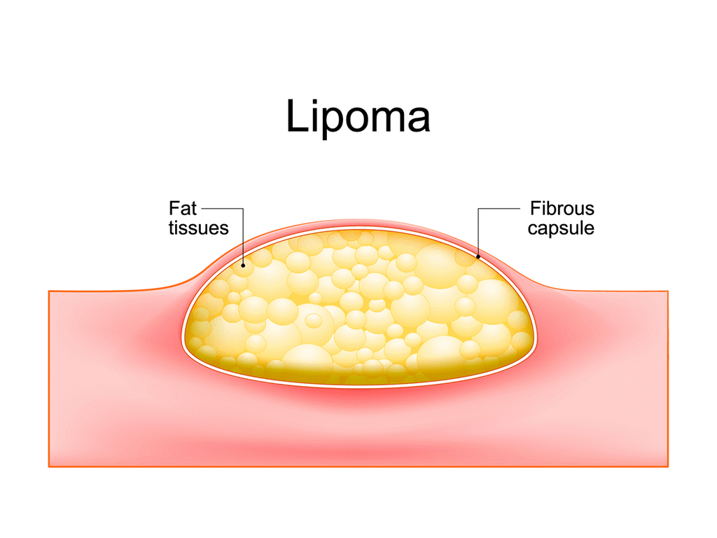 Cross-section diagram of a lipoma: a benign lump of fat tissue beneath the skin enclosed by a fibrous capsule under the surface.