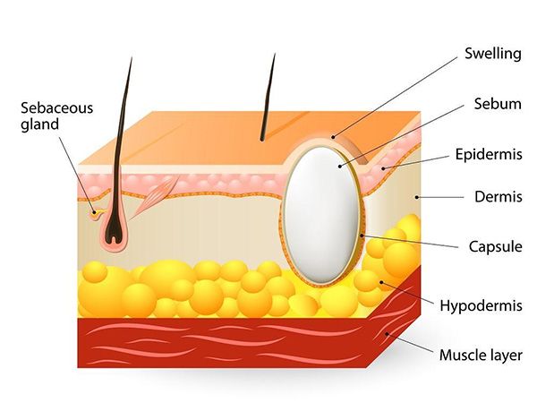 Cross-section of human skin showing hair follicle, sebaceous gland, and skin layers (epidermis, dermis, hypodermis) with fat tissue.