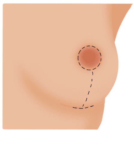 Anchor - Dr.Rajesh Vasu, - Dr.Rajesh Vasu, Medical illustration of an anchor-shaped breast lift incision: around the areola with a vertical line down and a curved line along the lower breast crease.