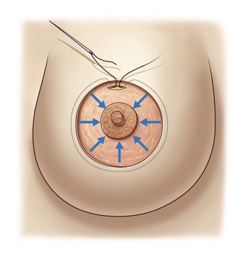 B9780702031687000518_f051-001-9780702031687 - Dr.Rajesh Vasu, - Dr.Rajesh Vasu, Cross‑section illustration of a breast showing a circular biopsy area near the nipple, with a needle approaching from the top and blue arrows pointing toward the center.