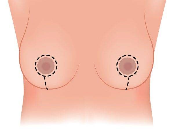 breast-reduction-incisions-cropped-edited-1 - Dr.Rajesh Vasu, - Dr.Rajesh Vasu,