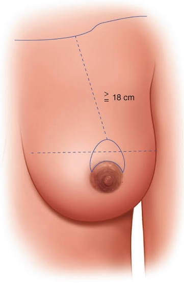 images - Dr.Rajesh Vasu, - Dr.Rajesh Vasu, Medical illustration of a breast with blue measurement lines showing a vertical distance greater than 18 cm from chest wall to nipple and a horizontal base measurement.