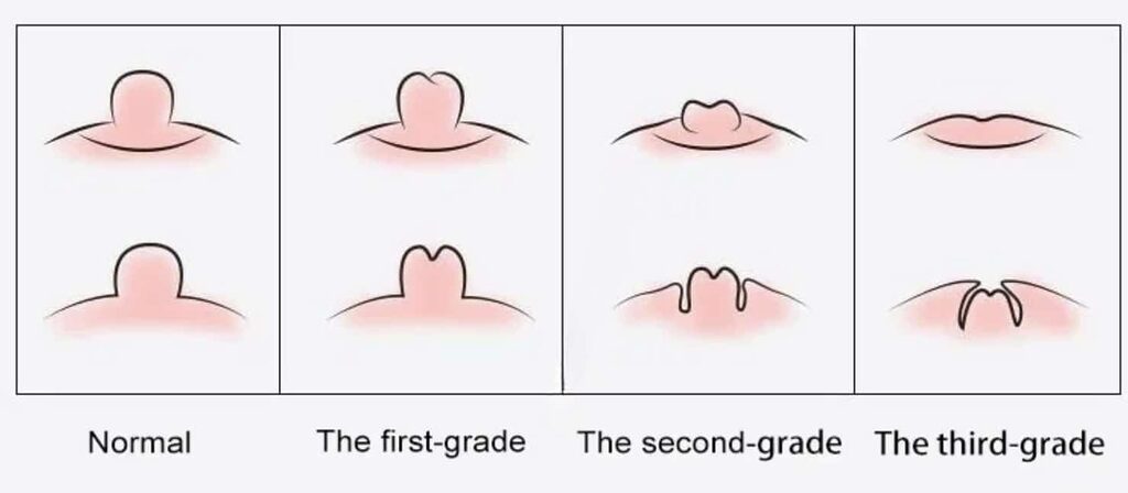 invertednipple - Dr.Rajesh Vasu, - Dr.Rajesh Vasu, Illustration showing progression from normal to first-, second-, and third-grade hemorrhoids (stages of a medical condition).